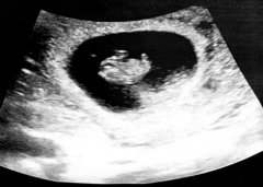  钟嘉欣怀二胎----香港抽血验染色体识别胎儿性别